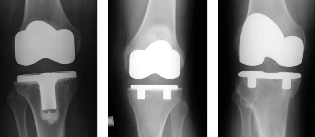 Cementless tibial components have excellent implant survivorship with no cases of aseptic tibial loosening at 10 years follow up