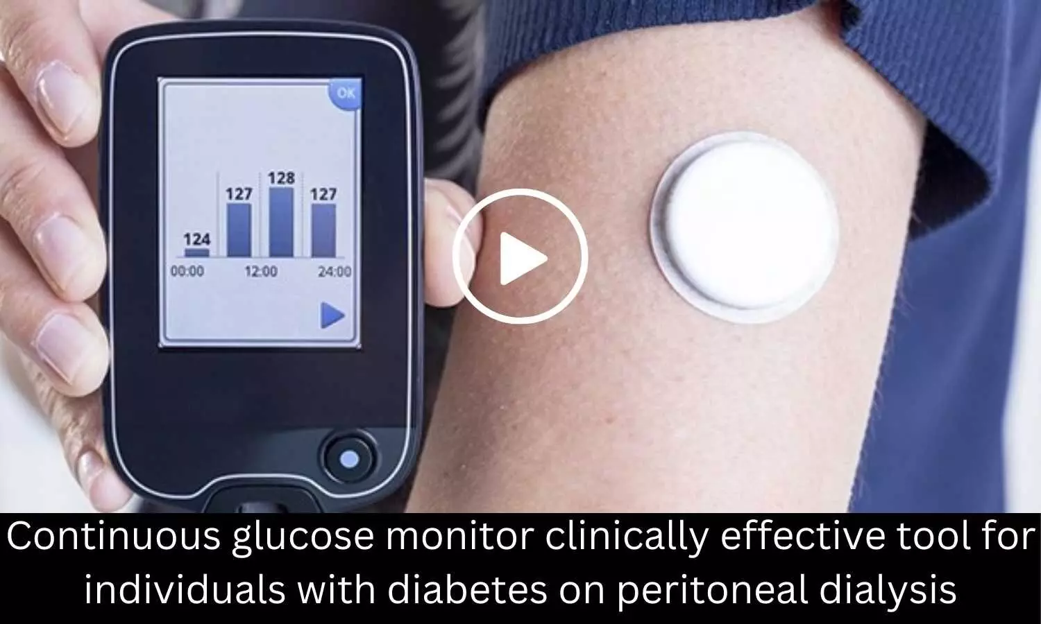 Continuous glucose monitor  clinically effective tool for individuals with diabetes on peritoneal dialysis