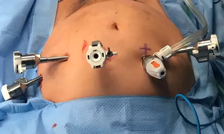 Robot Assisted redical cystectomy reduces short-term morbidity and is cost effective