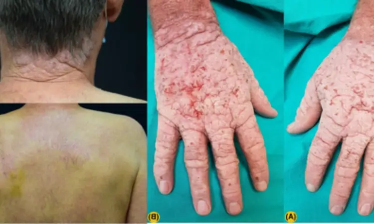 Case of chronic actinic dermatitis gets successfully treated with alitretinoin: A Report
