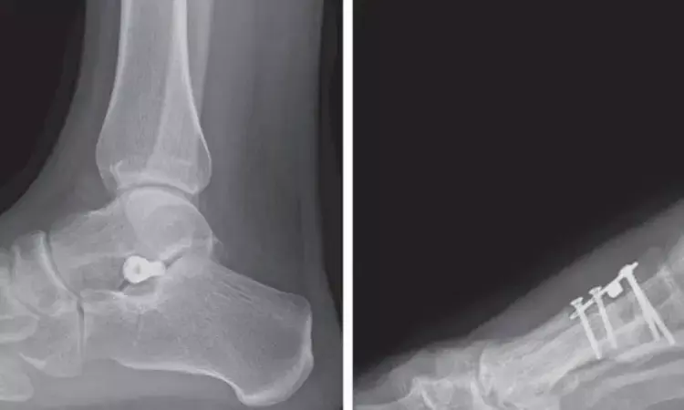 Subtalar arthroereisis with HyProCure-I implant yields good results in progressive collapsing Foot Deformity