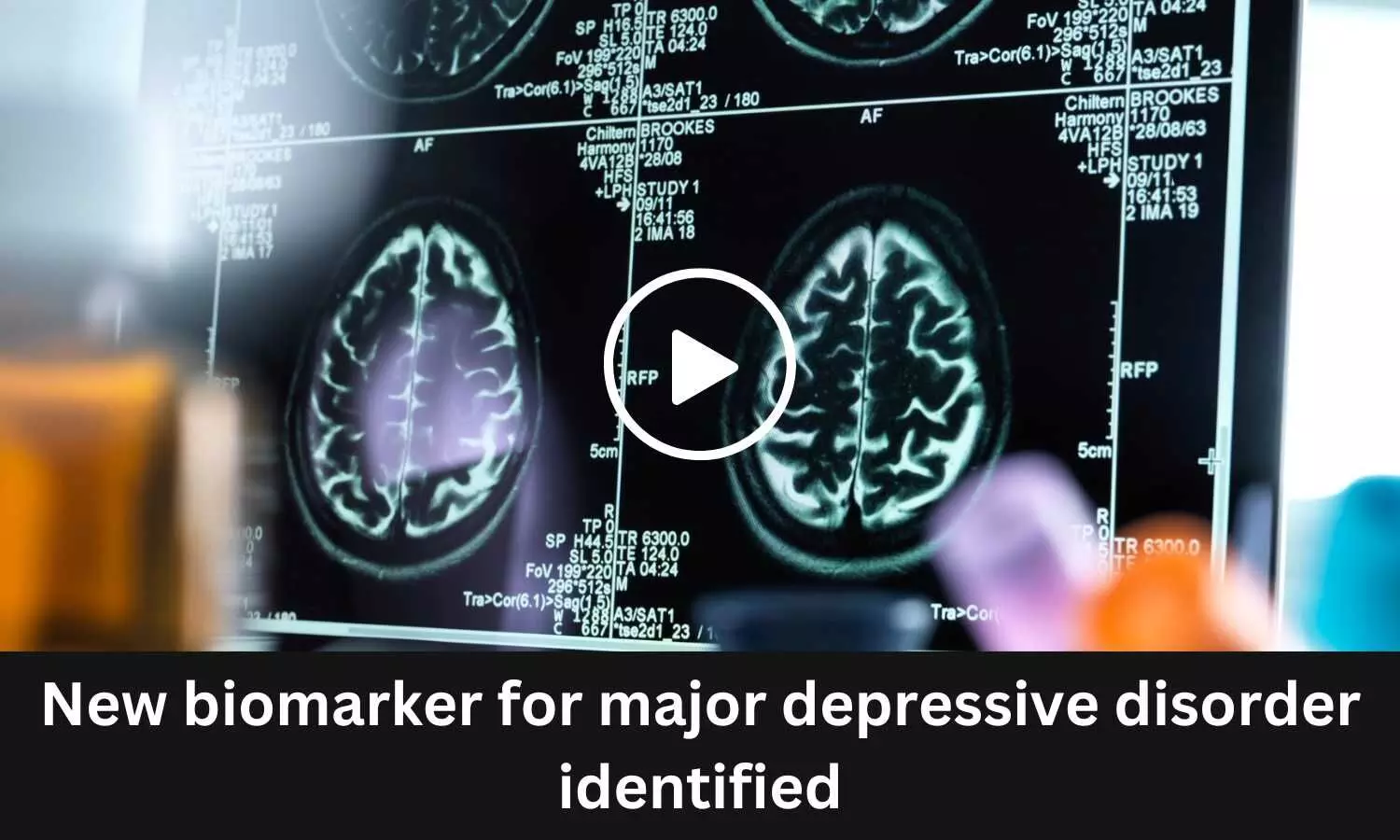 New biomarker for major depressive disorder identified