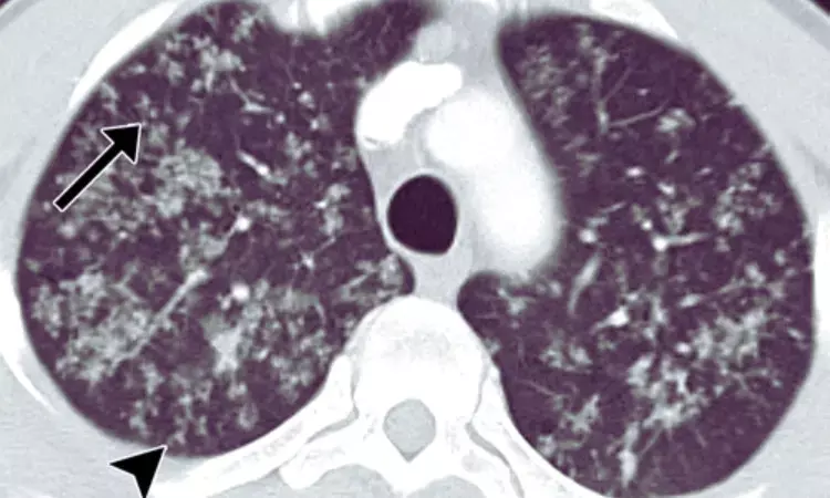 Subpleural nodules and septal thickening diagnostic of pulmonary TB with pleural effusion on CT chest: Study