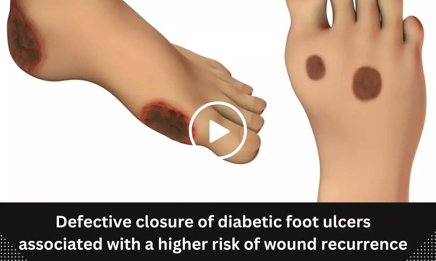 Defective closure of diabetic foot ulcers associated with a higher risk of wound recurrence