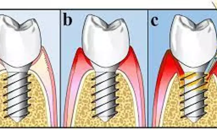 Supportive peri-implant care  may prevent peri-implantitis recurrence or progression