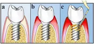 Supportive peri-implant care  may prevent peri-implantitis recurrence or progression