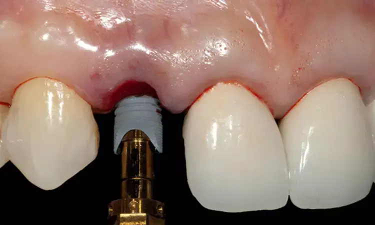 Immediate Implant Placement With Loading more beneficial in midfacial mucosal level in maxillary esthetic area