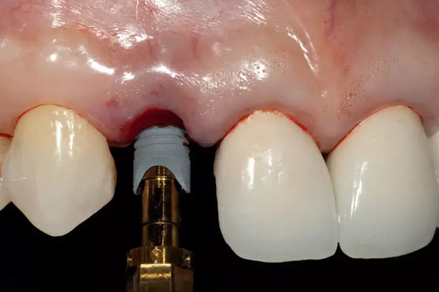 Immediate Implant Placement With Loading more beneficial in midfacial mucosal level in maxillary esthetic area