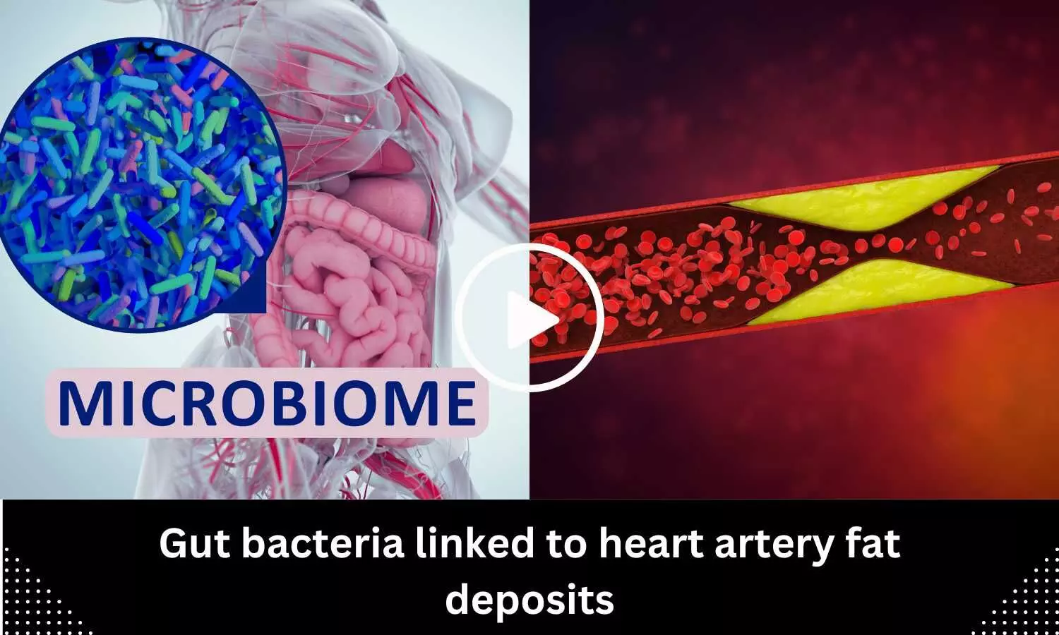 Gut bacteria linked to heart artery fat deposits