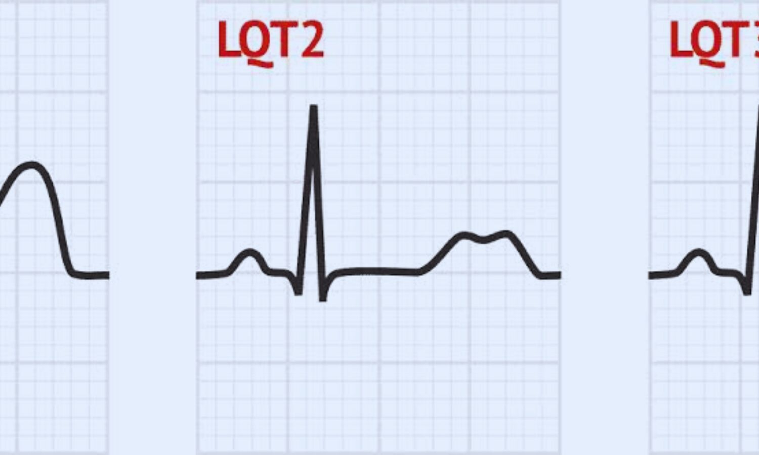 Trigger-specific syncope in Long QT syndrome tied to differential risk ...