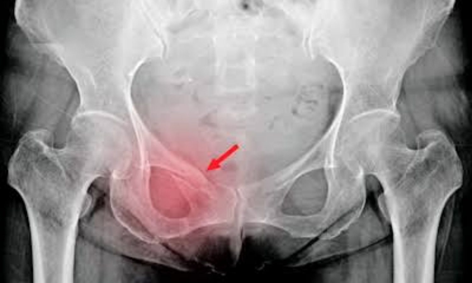 Artificial Intelligence Can Accurately Detect Hip Fractures On Pelvic X