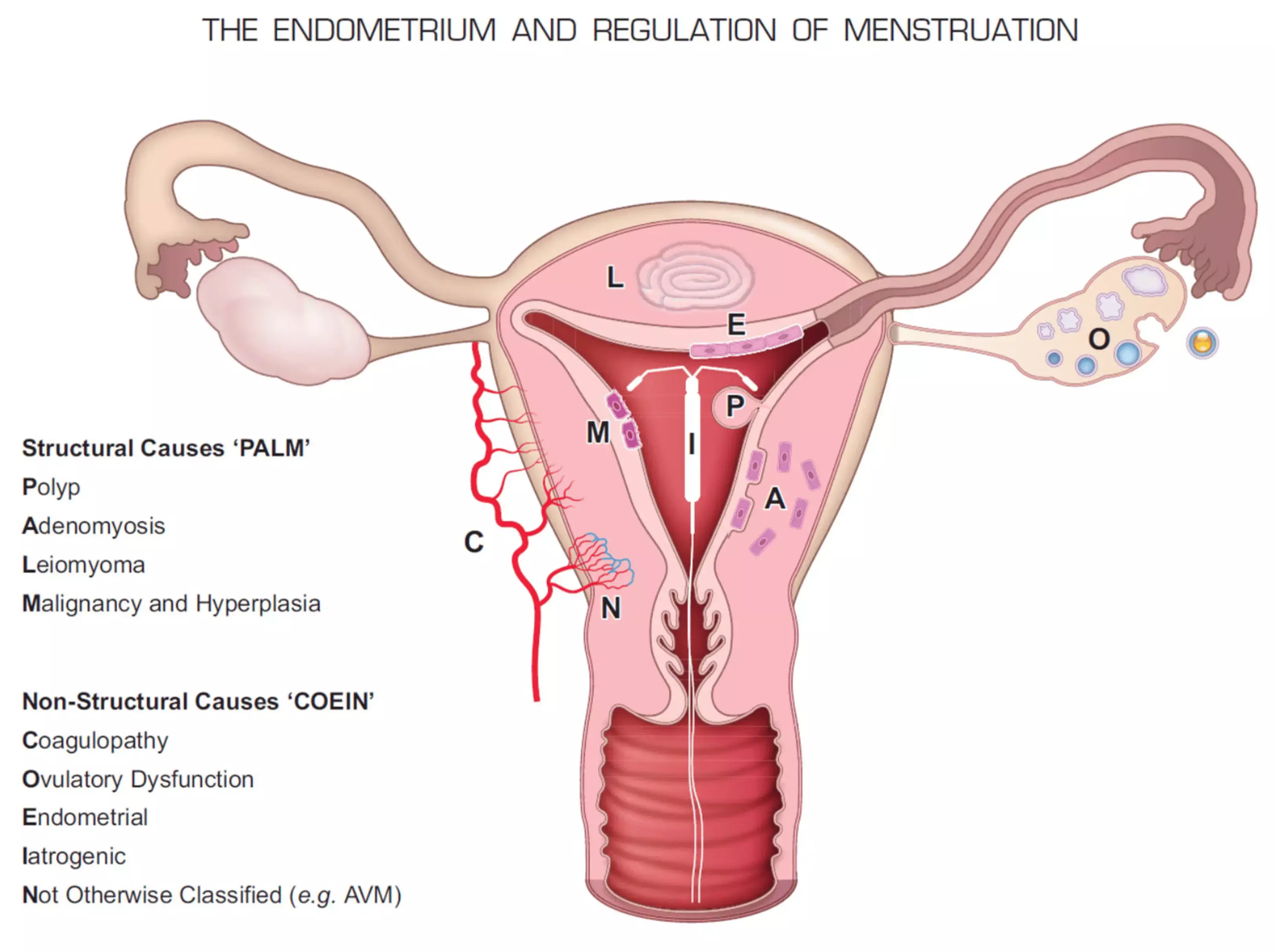Женские эндометрии. Классификация полипов эндометрия. Полип эндометрия в матке.