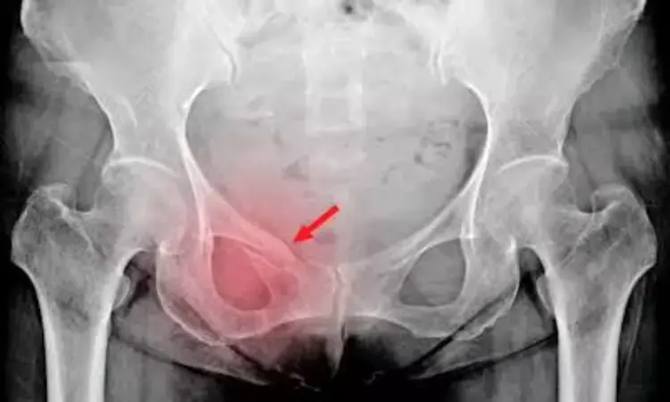 Artificial intelligence can accurately detect hip fractures on pelvic x-rays