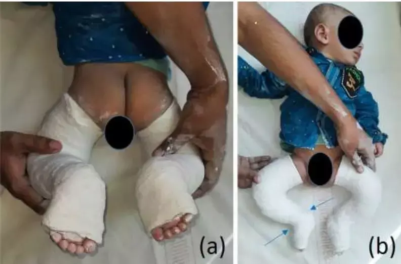 Modified Ponseti Casting simple and reliable method to improve efficacy of casting in complex clubfoot