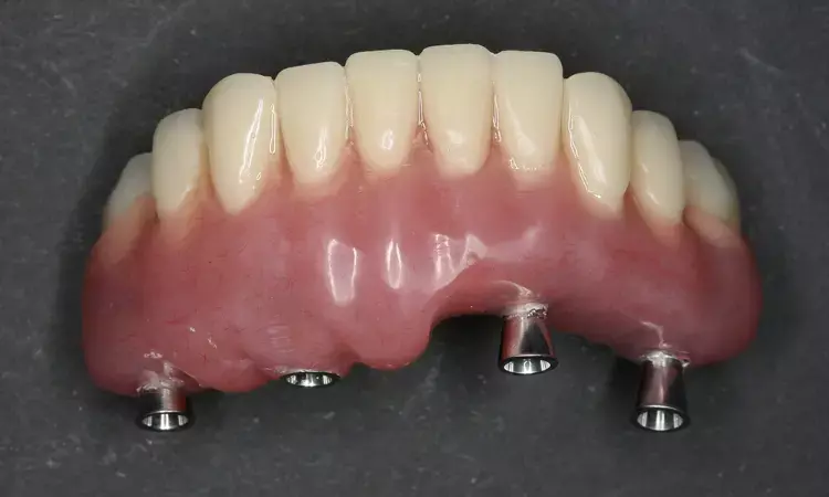 Pontic and mucosa noncontact prosthetic design reduces plaque accumulation on fitting surface, improves oral hygiene