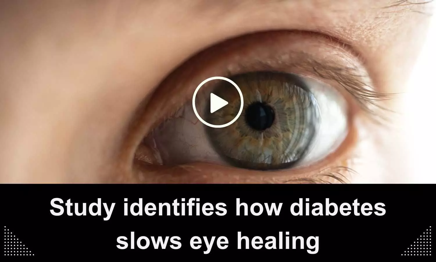 Study identifies how diabetes slows eye healing