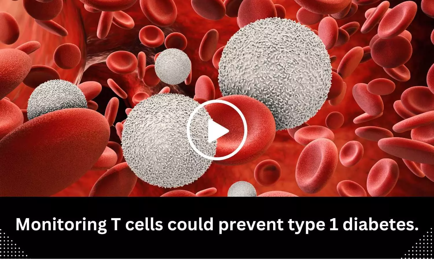 Monitoring T cells could prevent type 1 diabetes