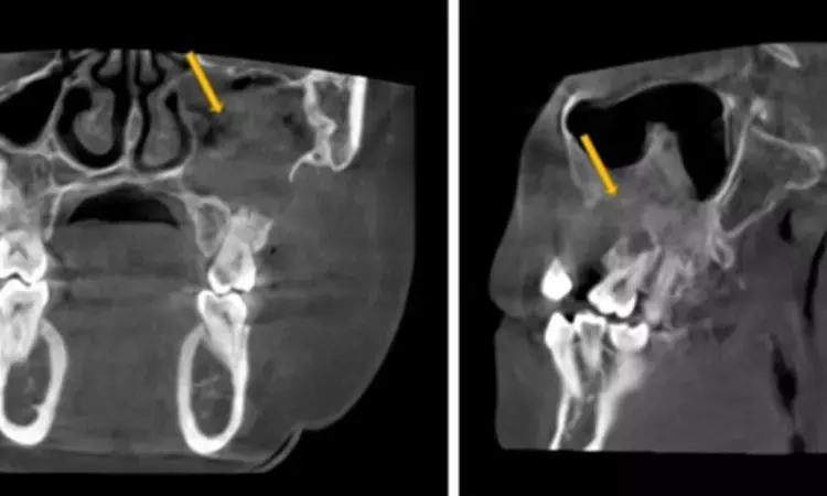 Compared to panoramic radiography,   CT/CBCT has significantly higher sensitivity for detecting maxillary sinusopathies