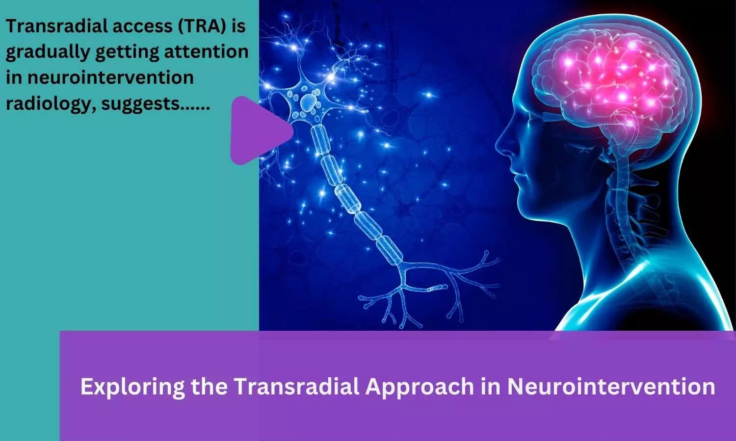 Exploring the Transradial Approach in Neurointervention