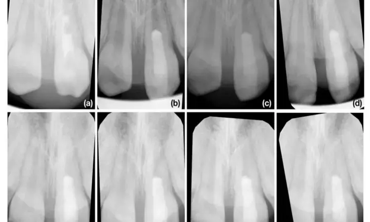 Endodontically treated traumatized immature teeth can remain functional for long time