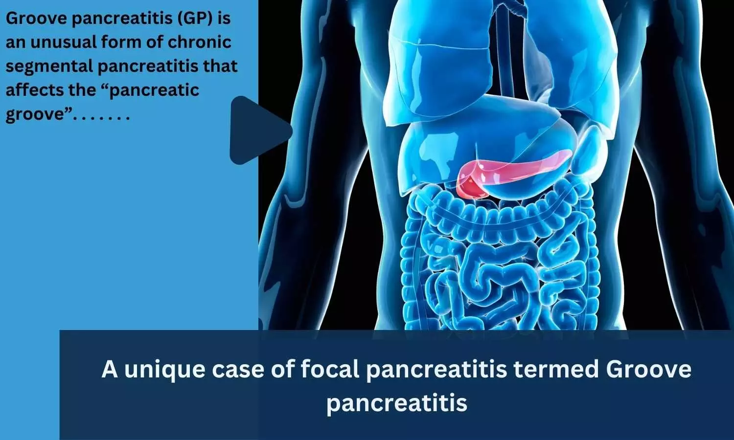 A unique case of focal pancreatitis termed Groove pancreatitis