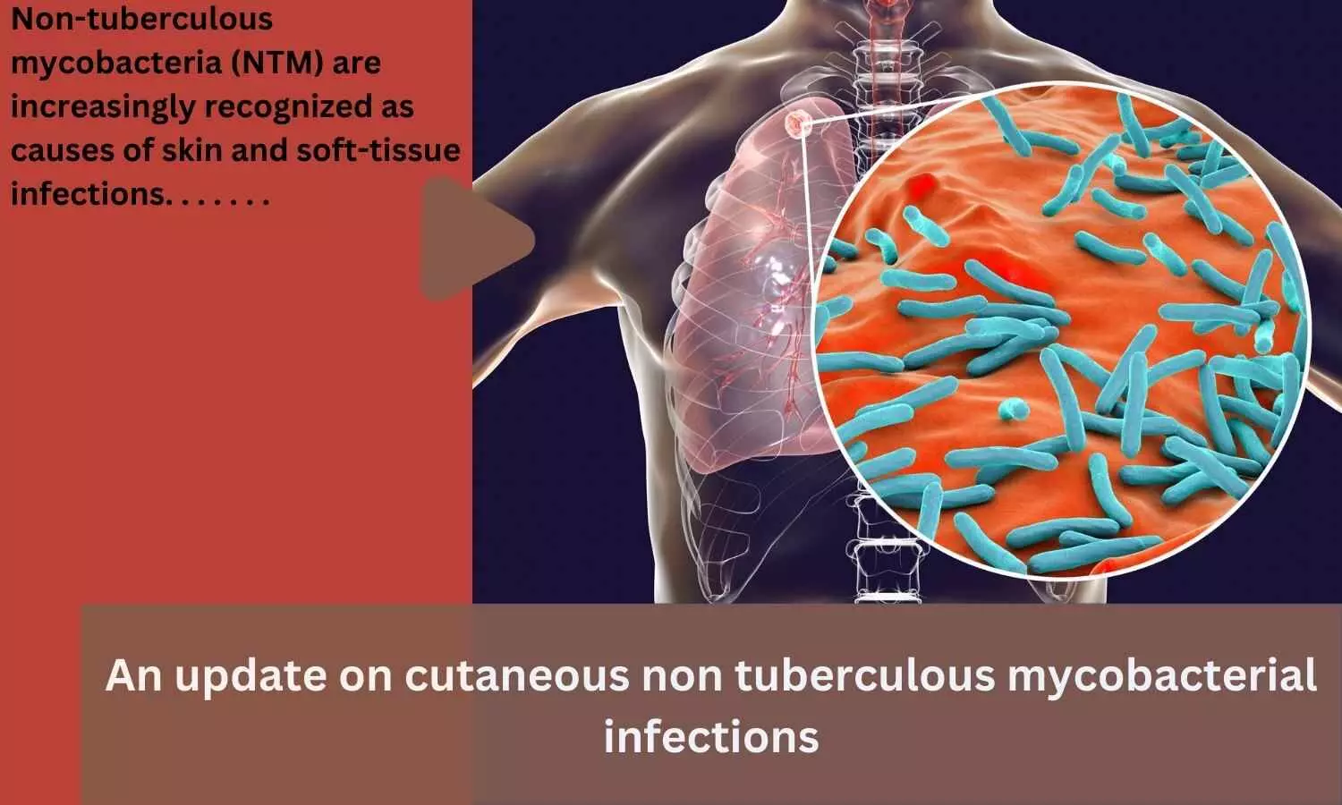 Nontuberculous Mycobacteria (NTM) Infections Mycobacterial