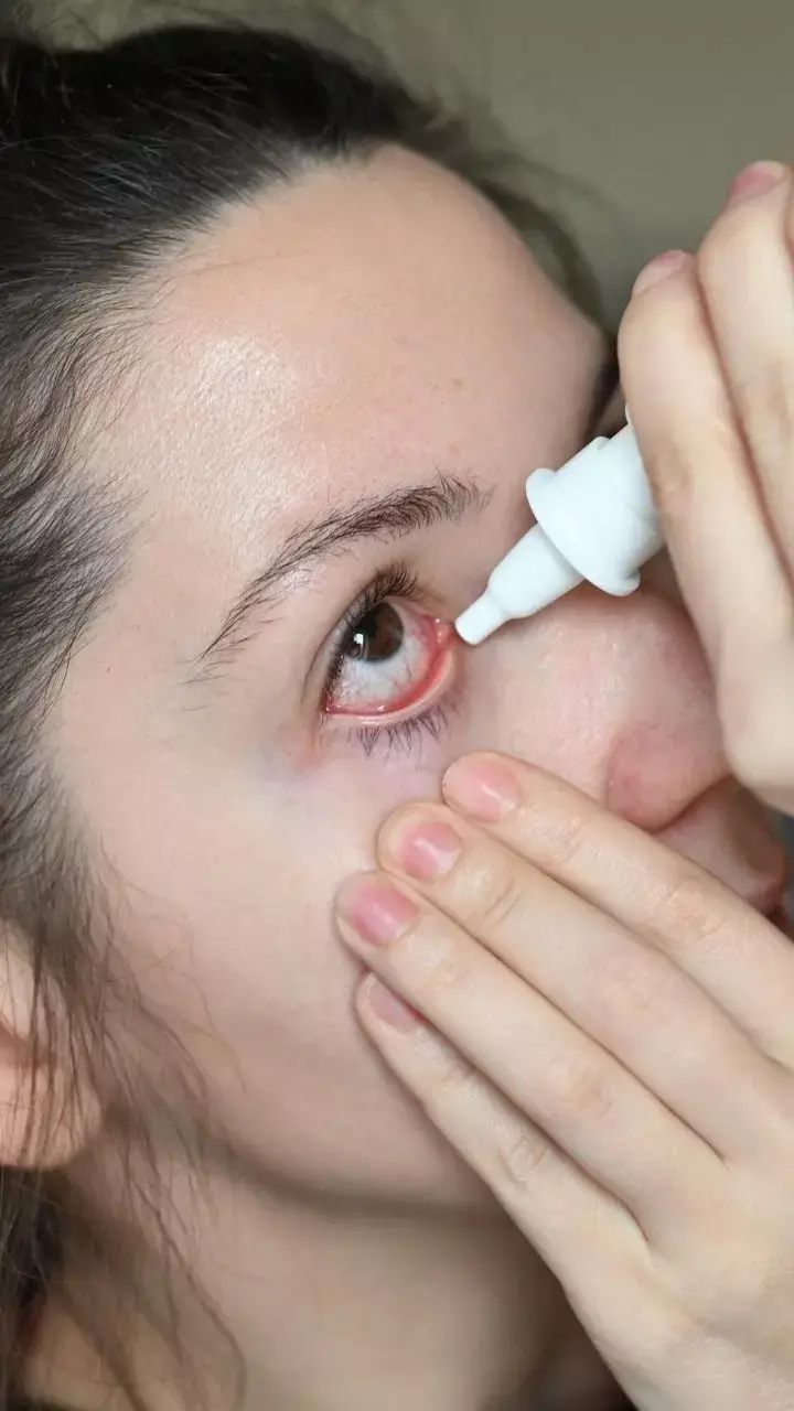 Conjunctivitis Cases Spike In Delhi-Ncr:  Here Are Tips To Prevent Red Eye Infection