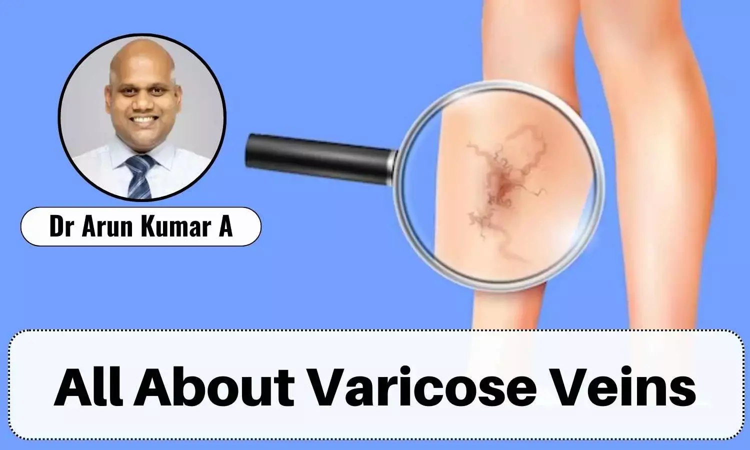 Varicose Veins: Causes, Symptoms And Treatment