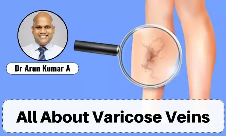 Understanding Varicose Veins: Causes, Symptoms, and Treatment Options - Dr Arun Kumar A