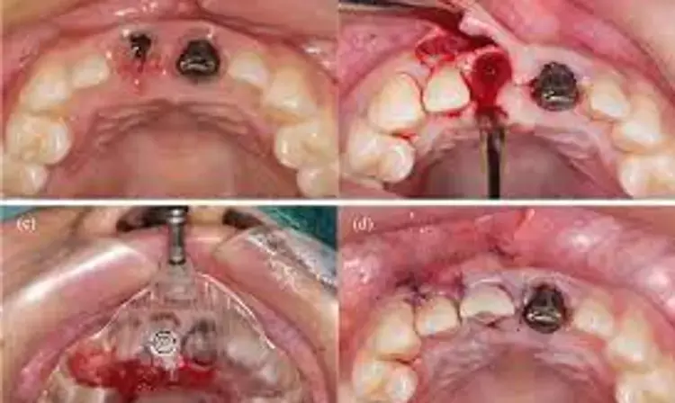 Static-guided surgery more accurate compared to freehand surgery for immediate implant placement in fresh extraction sockets