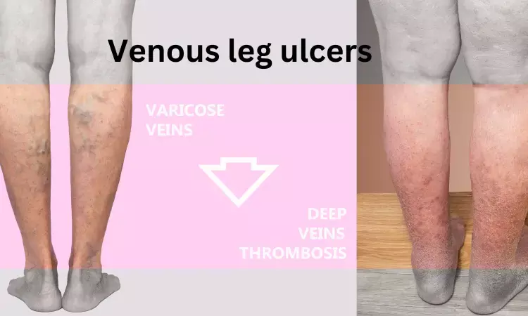 Combined endovenous ablation and compression may speed up venous leg ulcers healing