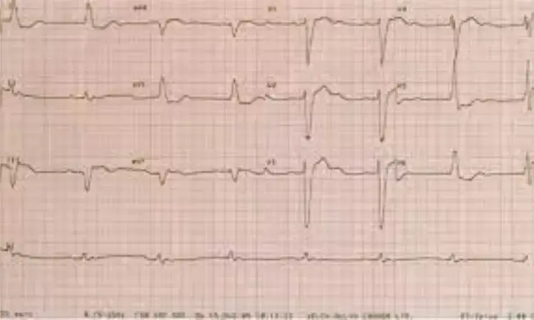 ECG images with AI useful for screening of LV systolic dysfunction
