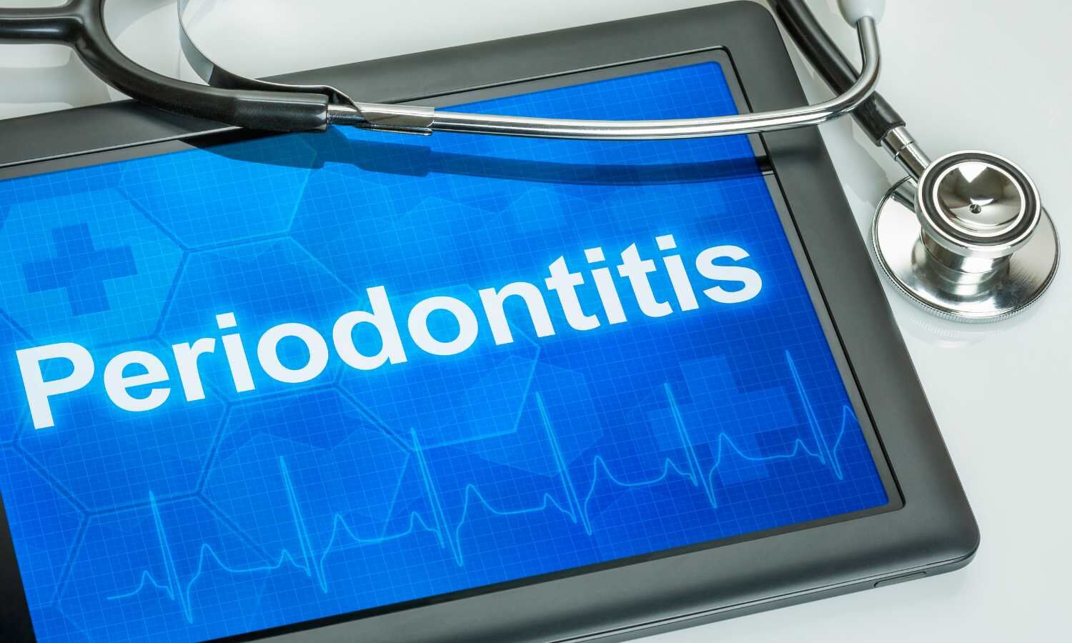 How periodontitis-linked bacteria accelerate osteoporosis-like bone loss through gut, finds research