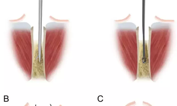 Scooping Technique for iliac crest may harvest substantial amount of autogenous cancellous bone using small incision