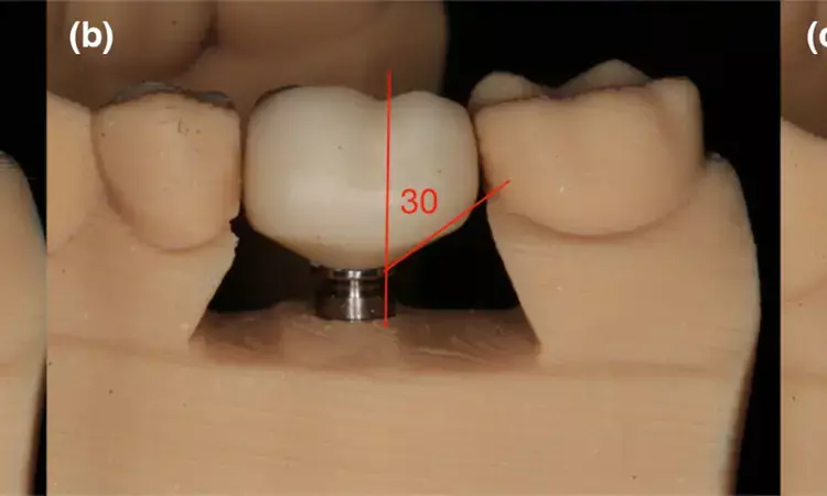 Subtle variations in contour of single-crown implant restorations may impact biofilm accumulation and mucosal  inflammation