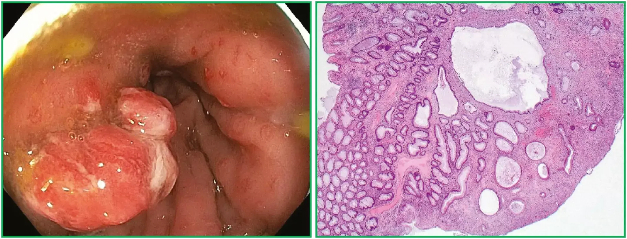 Solitary Juvenile Polyps carry very low risk of malignant transformation