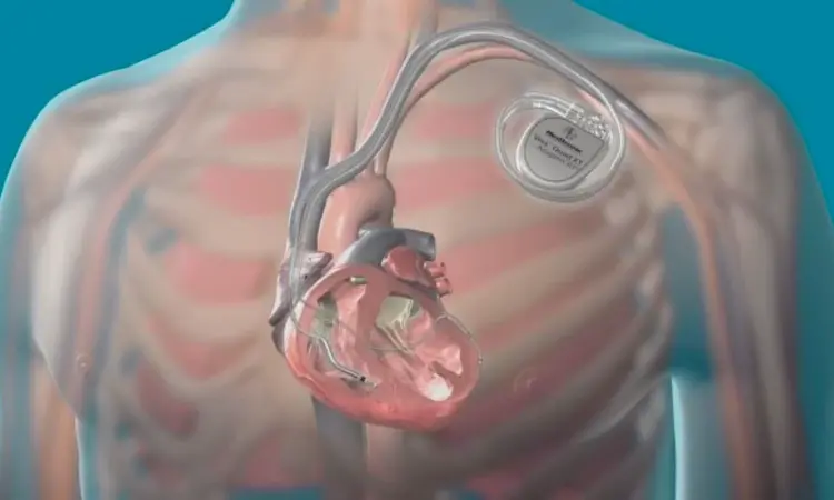 Nonindicated dual-chamber ICDs implantation for prevention of tied to complications