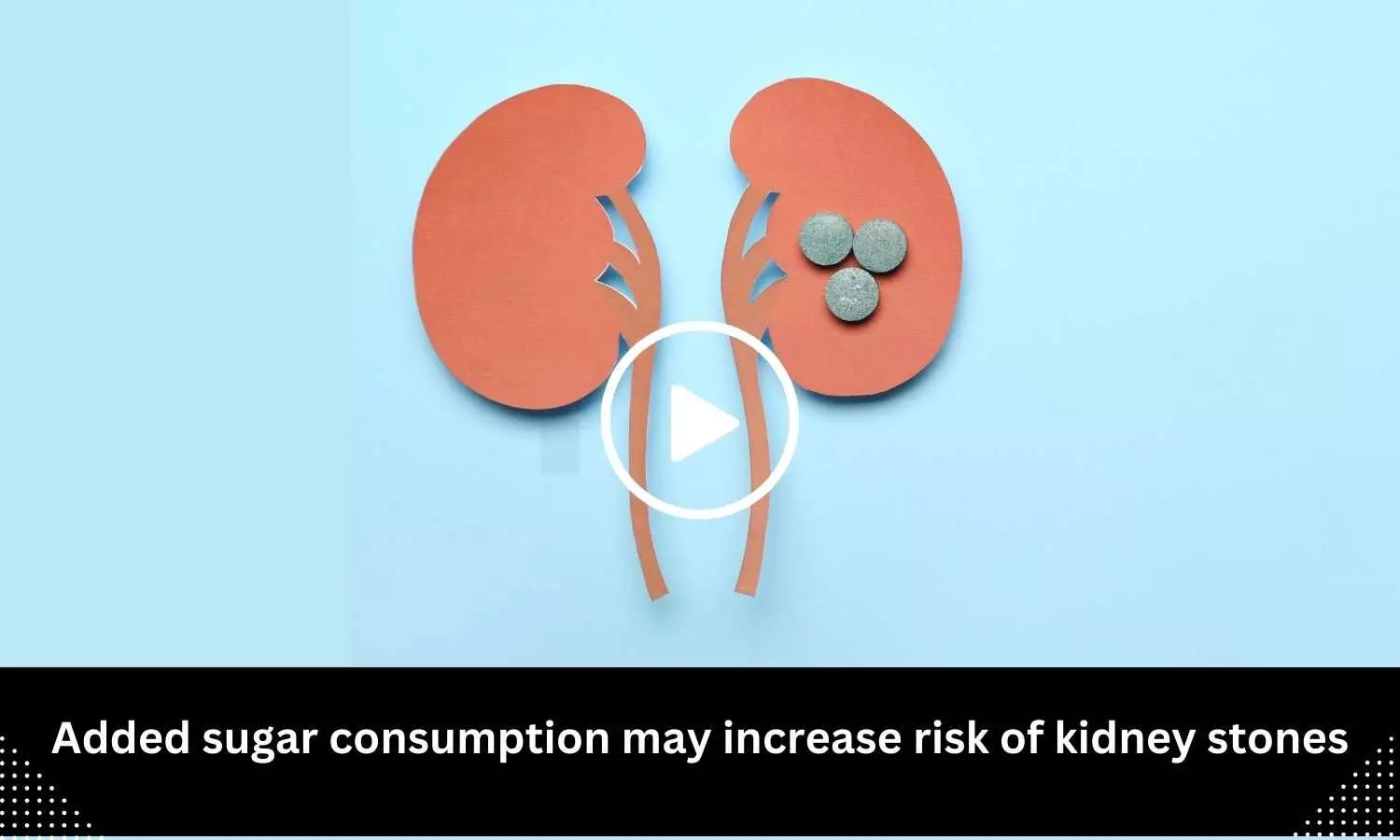 Added sugar consumption may increase risk of kidney stones
