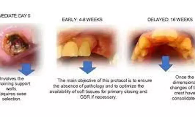 Immediate implant placement protocol and early and delayed placement protocols have comparable  aesthetics results