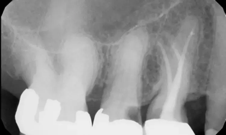 Primary root canal treatment failures in maxillary second premolars linked to complicated canal configurations