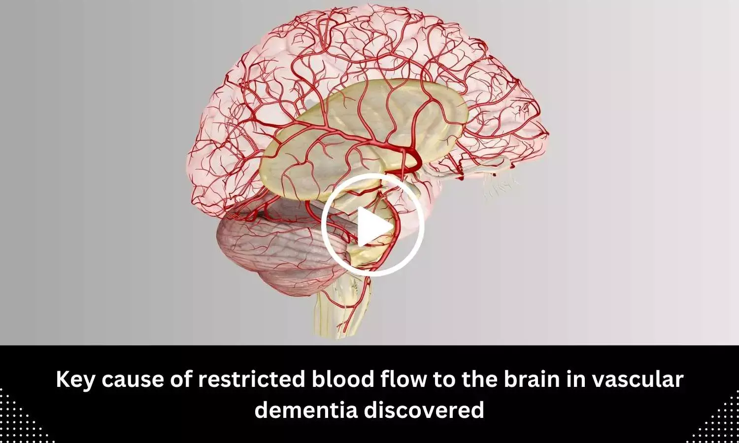 The Dysautonomia Project - Brain fog, or mental clouding, occurs when  there is not an ideal amount of blood flow to the cerebral cortex. This  lower blood flow causes difficulties with concentrating