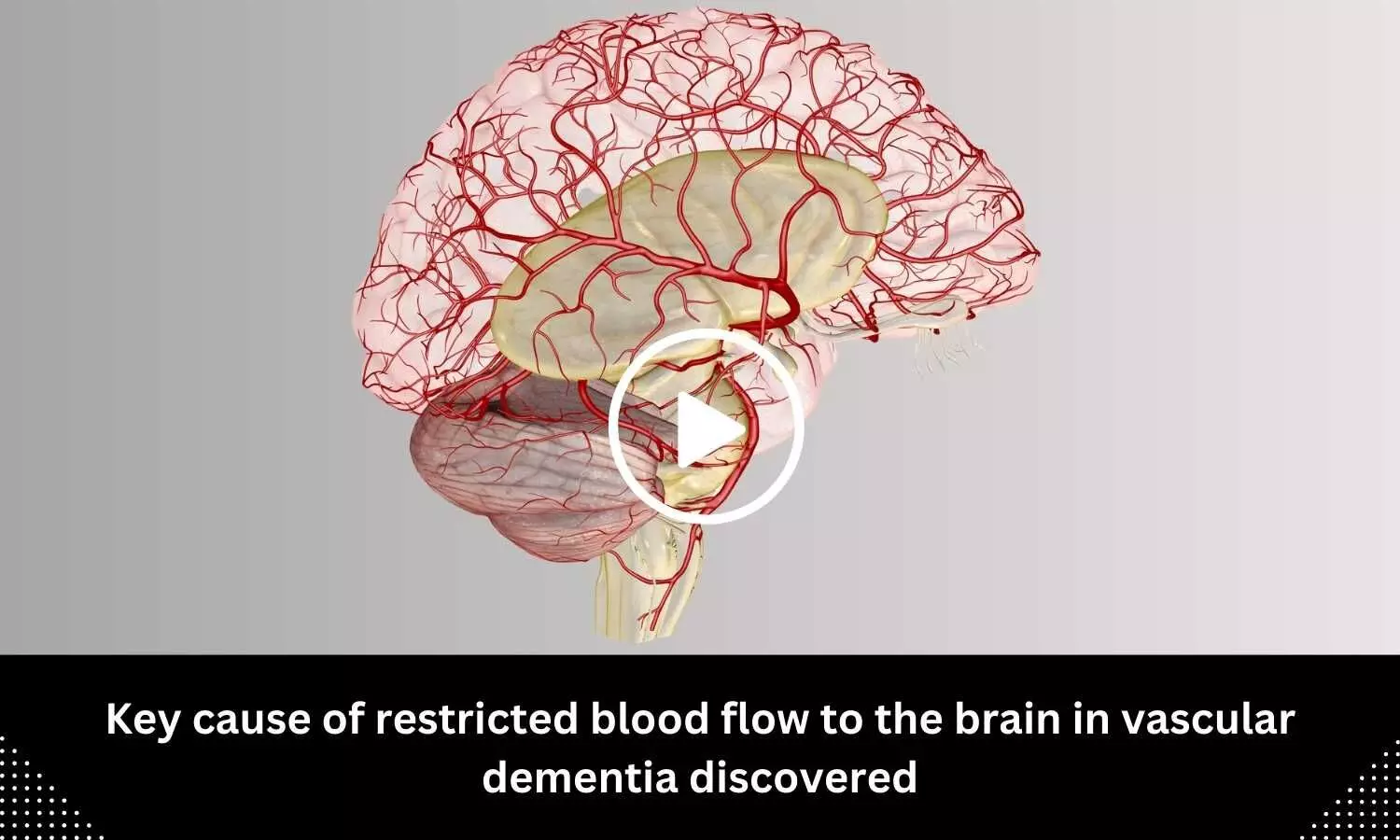 Key cause of restricted blood flow to the brain in vascular dementia discovered