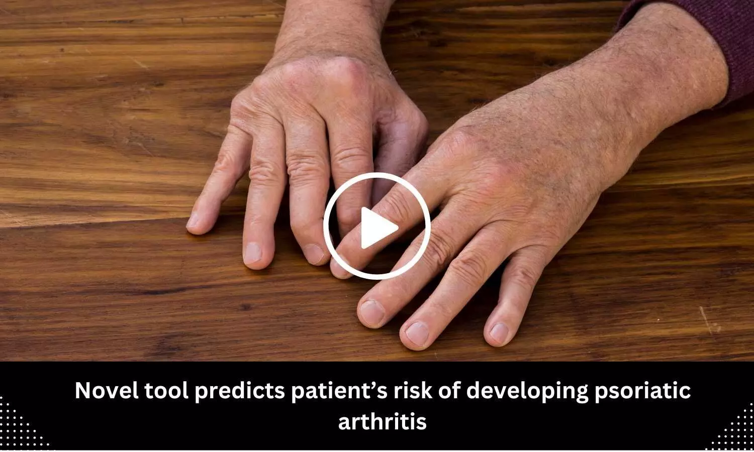 Novel tool predicts patients risk of developing psoriatic arthritis
