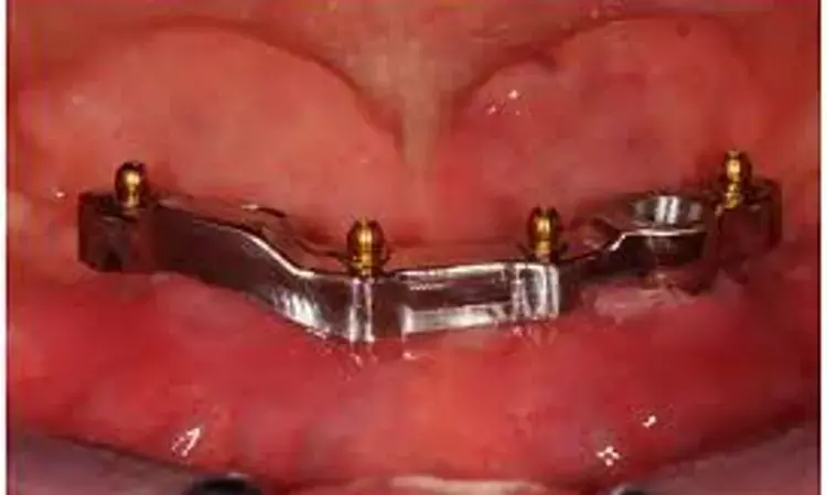 Implant survival time similar in immediately loaded two implant-supported overdenture retained with locator or bar attachments