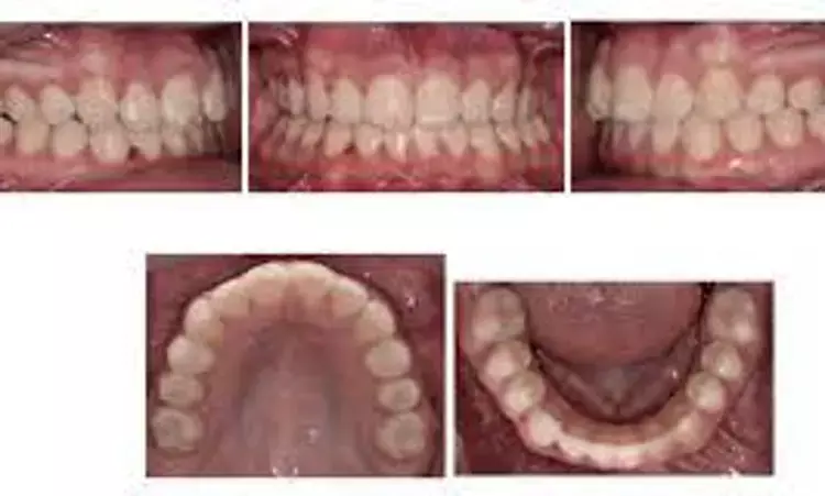 Molar-incisor hypomineralization may negatively impact oral symptoms, functionality and emotional health of kids