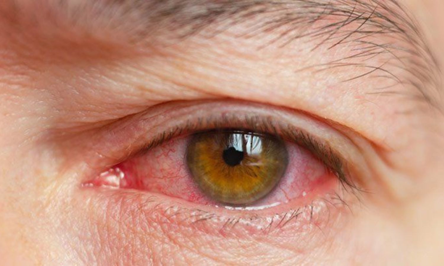 FDA Approves Travoprost Implant For Treatment Of Ocular Hypertension ...