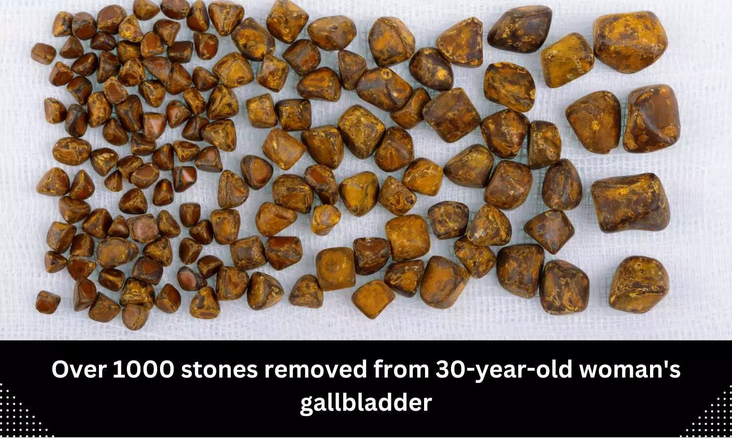 Over 1000 stones removed from 30-year-old womans gallbladder