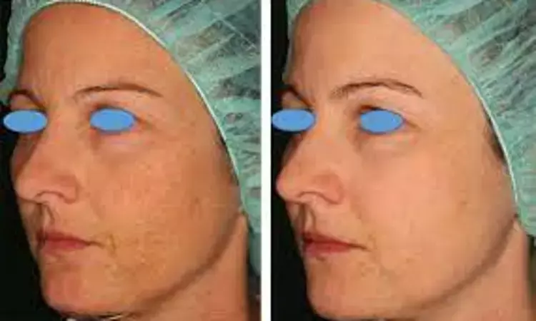 Hybrid laser treatments may generate safer and more promising facial rejuvenation results