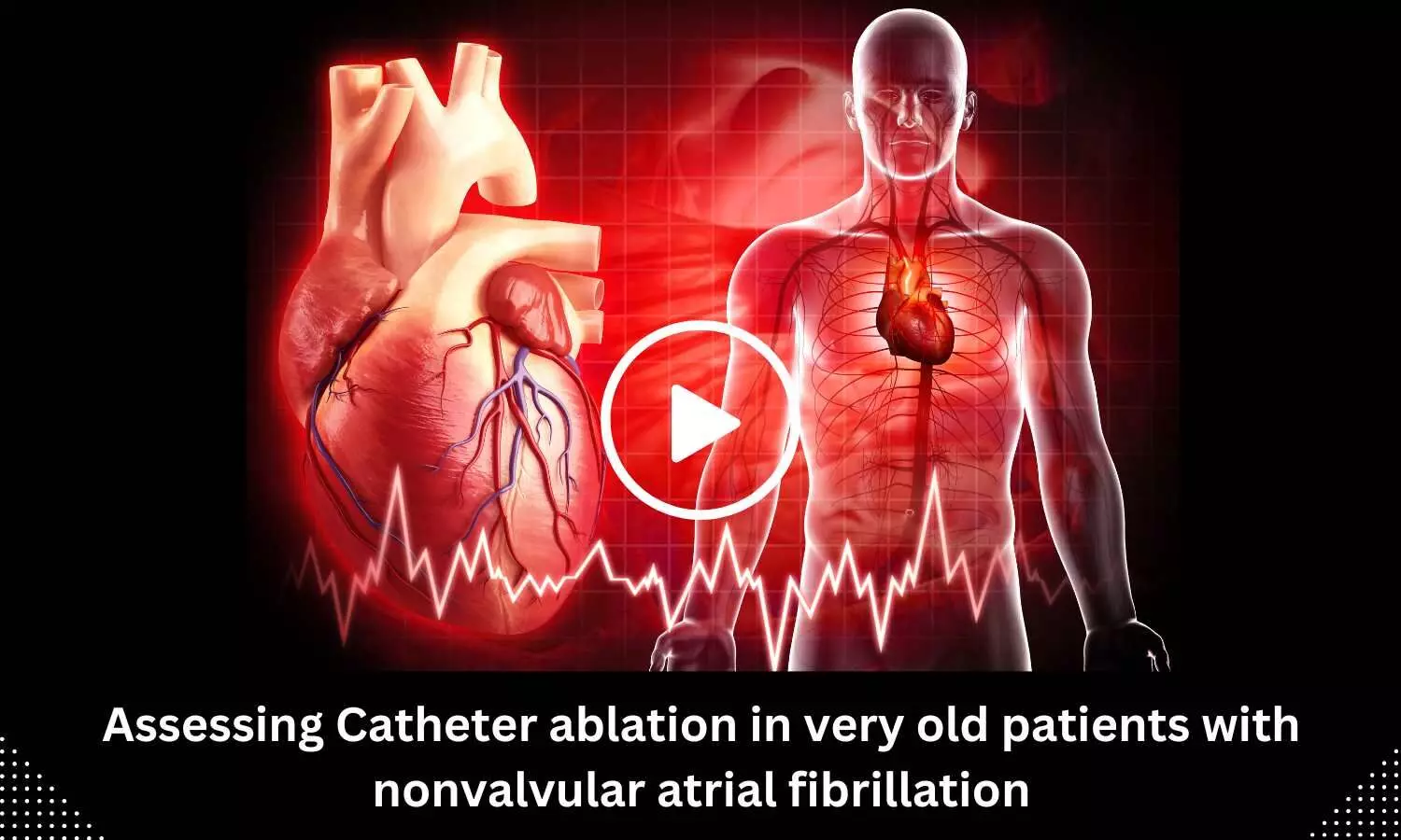 Assessing Catheter ablation in very old patients with nonvalvular atrial fibrillation