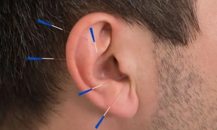 Auricular acupuncture potentially accessible treatment for type 2 diabetes